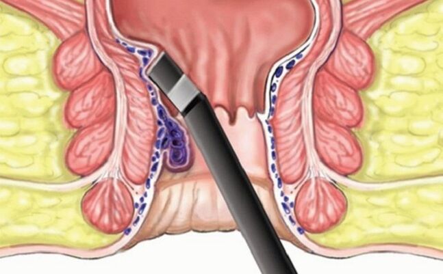 coagulation of hemorrhoids into hemorrhoids